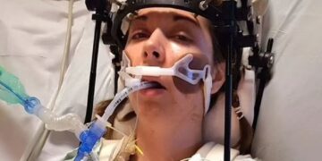 Πώς οι γιατροί ξανακόλλησαν το κεφάλι γυναίκας που είχε υποστεί εσωτερικό αποκεφαλισμό