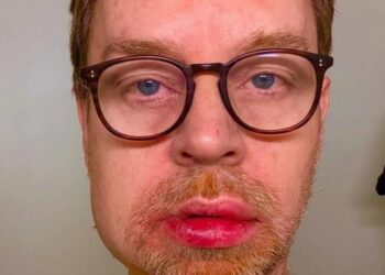 «Θα μπορούσα να είχα πεθάνει» – Το σοβαρό ατύχημα του πρώην τραγουδιστή των Savage Garden