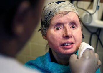 Φρίκη: Χιμπατζής διαμέλισε γυναίκα που χρειάστηκε να υποβληθεί και σε μεταμόσχευση προσώπου