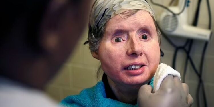 Φρίκη: Χιμπατζής διαμέλισε γυναίκα που χρειάστηκε να υποβληθεί και σε μεταμόσχευση προσώπου