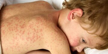 Σε υψηλό 25ετίας τα κρούσματα ιλαράς στην Ευρώπη