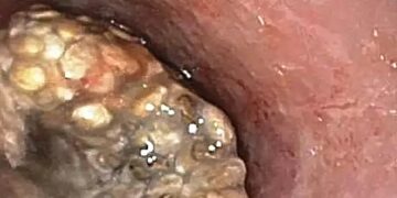 Έφραξε ο οισοφάγος ενός άνδρα έπειτα από κατανάλωση κοινής υπερτροφής